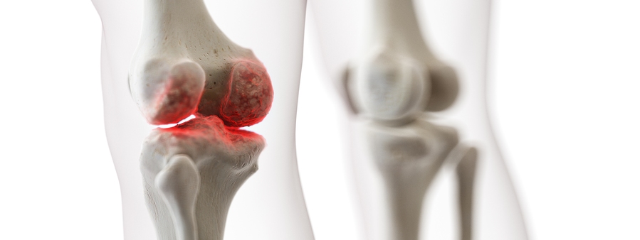 Osteoartróza je nejrozšírenější onemocnění kloubů