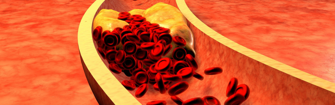 vysoky-cholesterol-mame-pro-vas-5-uzitecnych-tipu-jak-ho-snizit